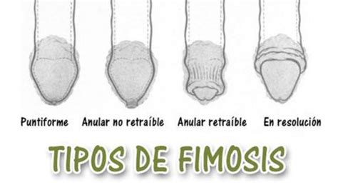 fimosis imagenes|Fimosis: cuándo operar, tipos, síntomas y postoperatorio